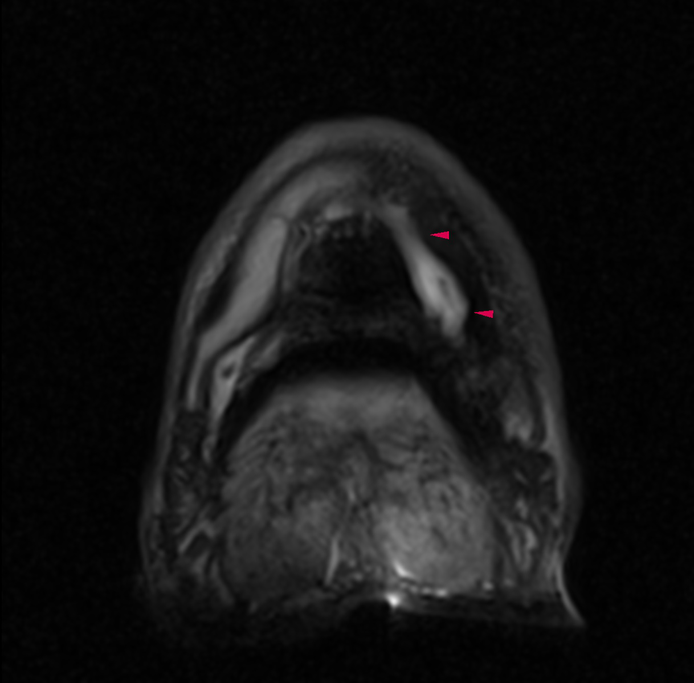 MRI3 arrows